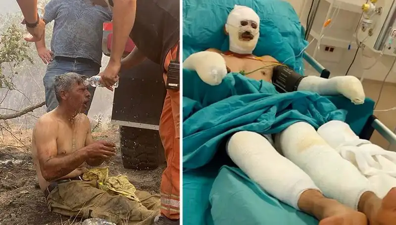 Yanıyorum Feryadı: Orman İşçisinin Yaşadığı Korkunç Kaza ve Tedavi Süreci
