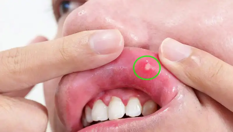 Kanser Belirtilerini Göz Ardı Etti: Dilinin Alınması Gerekti